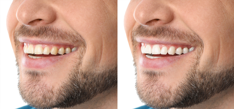 Natural Teeth Whitening in , 