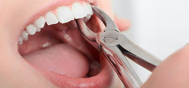 Tooth Extraction in Mesa